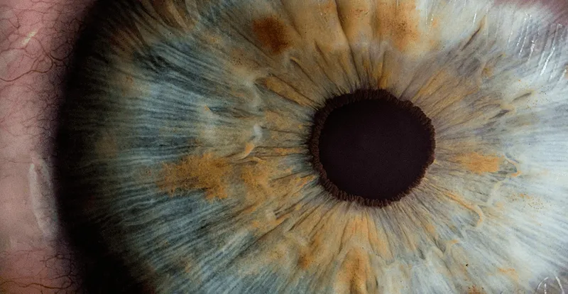 Intracameral bevacizumab for rubeotic glaucoma secondary to retinal vein occlusion